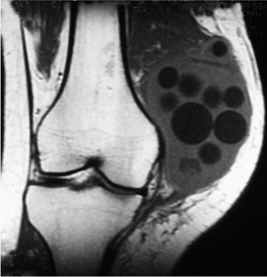 Hydatid Cyst of the Knee {faces}